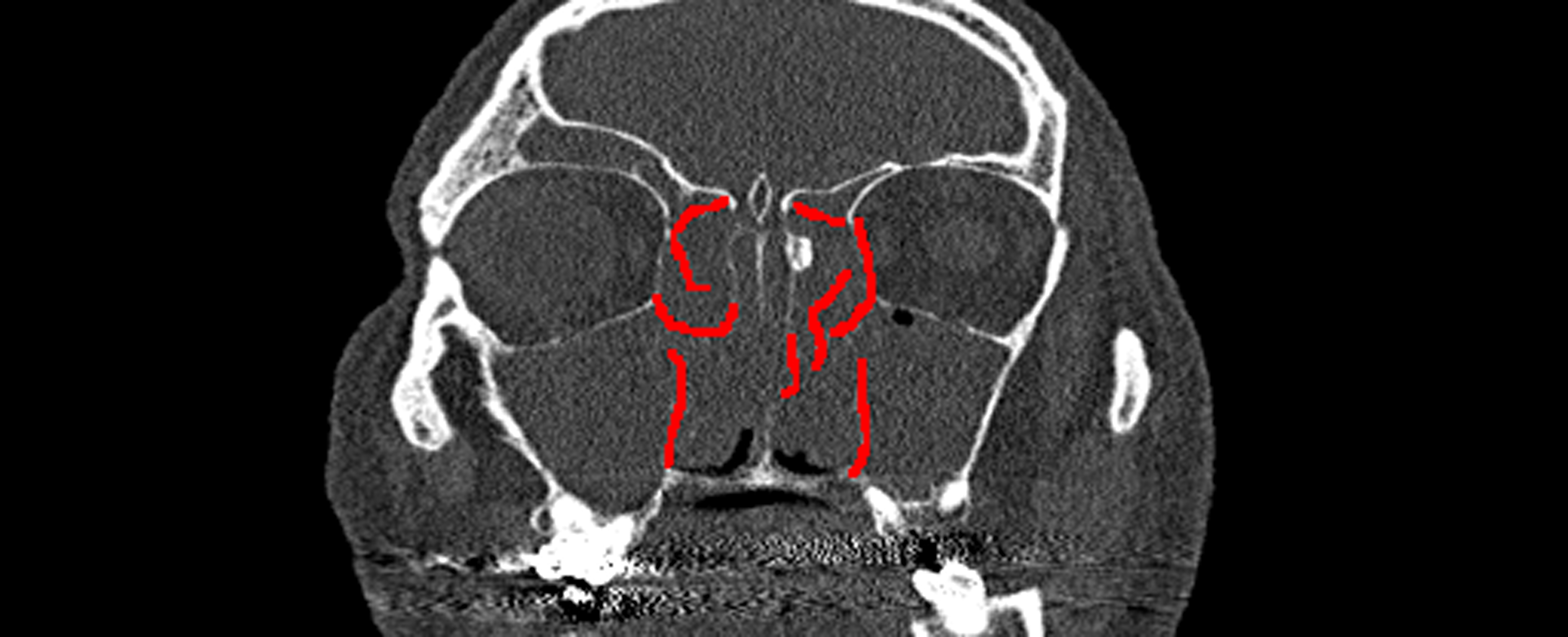 Bone Erosion After Hover