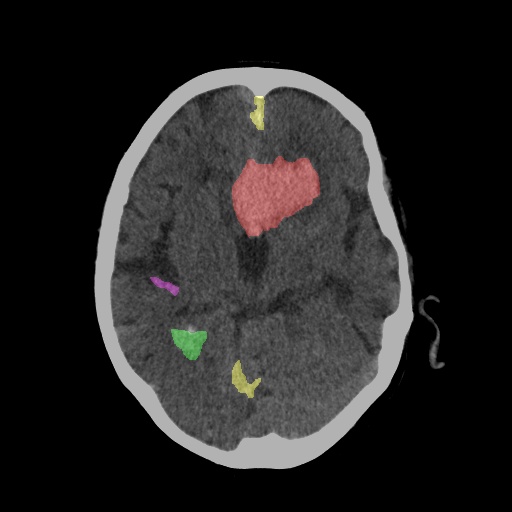 CT Scan After Diagnosis with Segmentation
