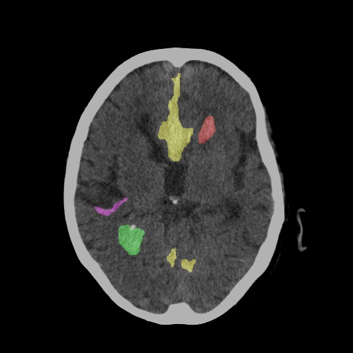 CT Scan After Diagnosis with Segmentation
