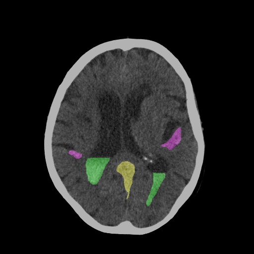 CT Scan After Diagnosis with Segmentation